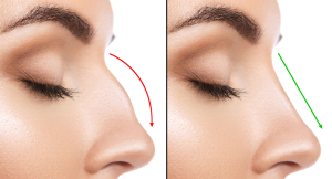 Does the tip drop after rhinoplasty?