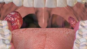 Burun estetiği ile  beraber yapılabilen ameliyatlar: rinoplasti ve tonsillektomi (bademcik) 